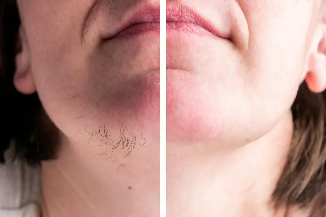 laser treatment for hair removal