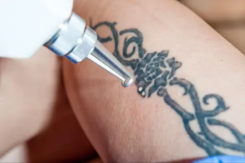 laser tattoo removal performed by the expert dermatologist in Kannur