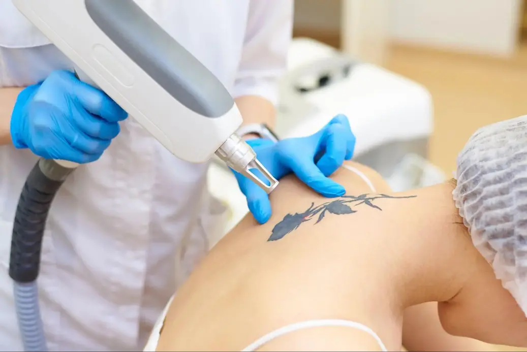 Dermatologist performing laser tattoo removal on a patient