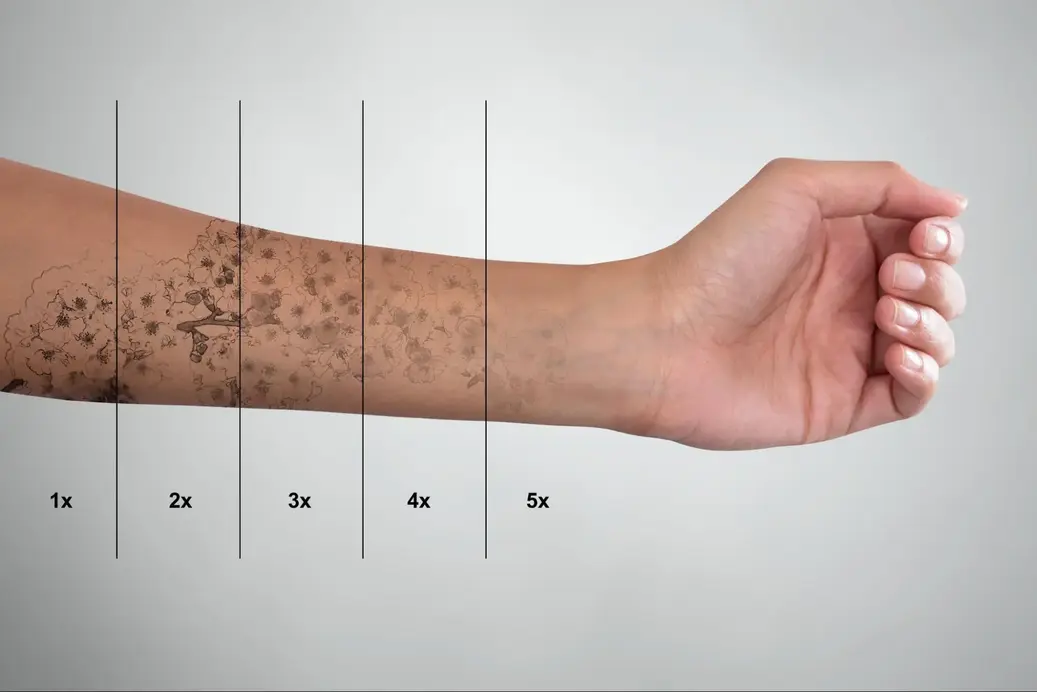 Tattoo gradually disappearing under laser treatment