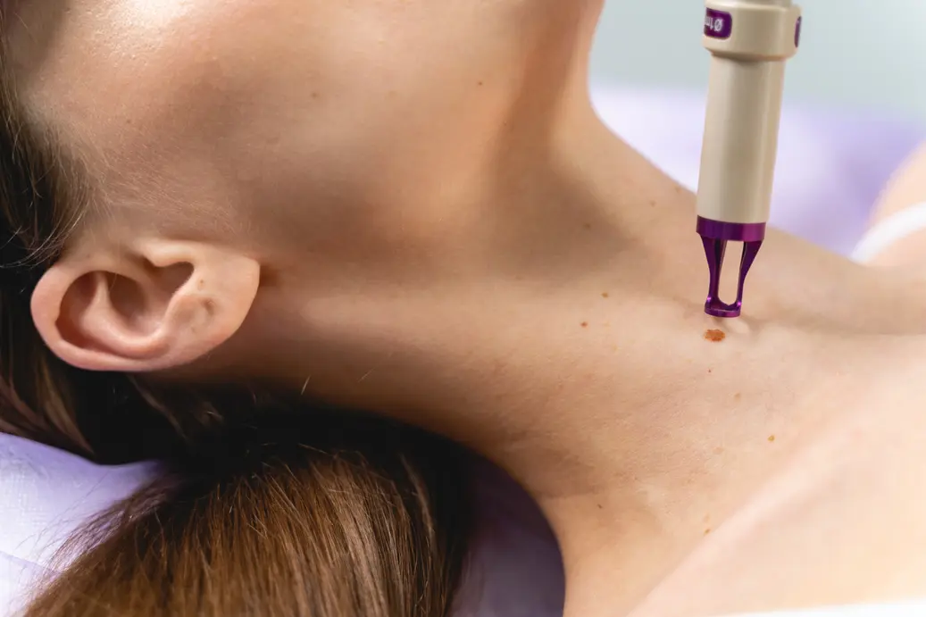 Chemical Peel Treatment